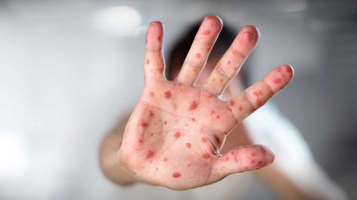 Una persona con sarampión puede infectar a otras 16, advierte la UNAM