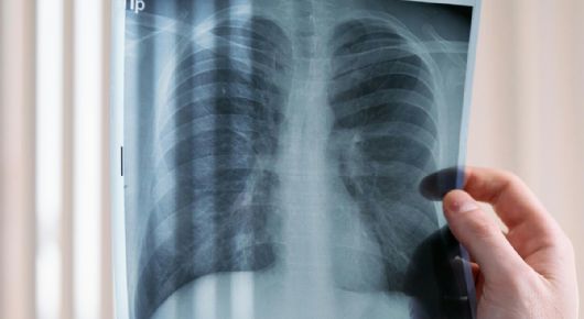 Cáncer de pulmón en México: ¿además del tabaco qué otras cosas lo causa?