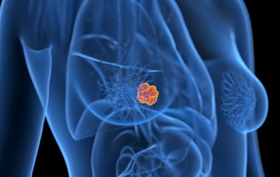 Anuncian avances en el tratamiento contra el cáncer de mama