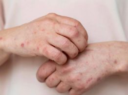 Brote de sarampión en México: ¿Qué se debe hacer en caso de contagio y cuánto dura la enfermedad?