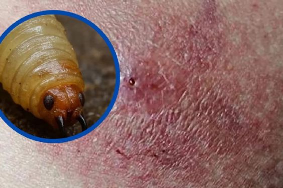 Foto de: Emiten alerta sanitaria por caso de miasis por gusano barrenador en humanos