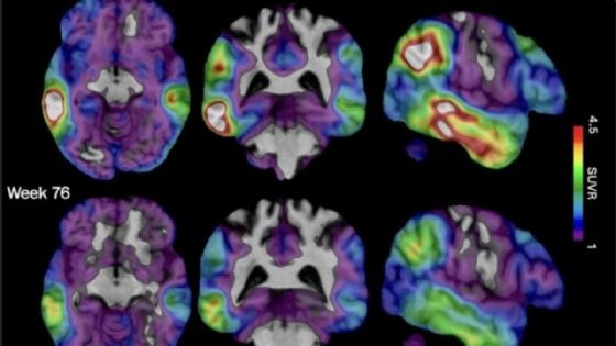 Foto de: Un análisis de sangre podría detectar la enfermedad de Alzheimer hasta 10 años antes de que se desarrollen síntomas