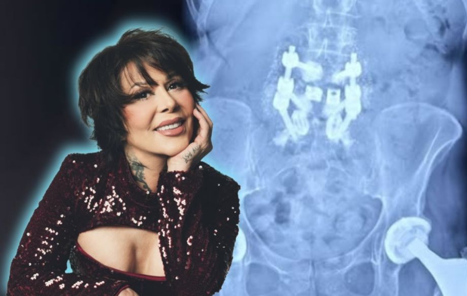 “Soy de titanio”: Así han sido las tres lesiones por las que Alejandra Guzmán tiene dos placas de titanio 